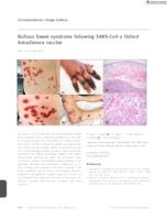 prikaz prve stranice dokumenta Bullous Sweet syndrome following SARS‐CoV‐2 Oxford AstraZeneca vaccine