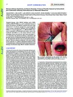 prikaz prve stranice dokumenta Stevens-Johnson Syndrome and Severe Anaemia: A Case of Toxicity Induced by Vemurafenib plus Cobimetinib following Pembrolizumab for Metastatic Melanoma